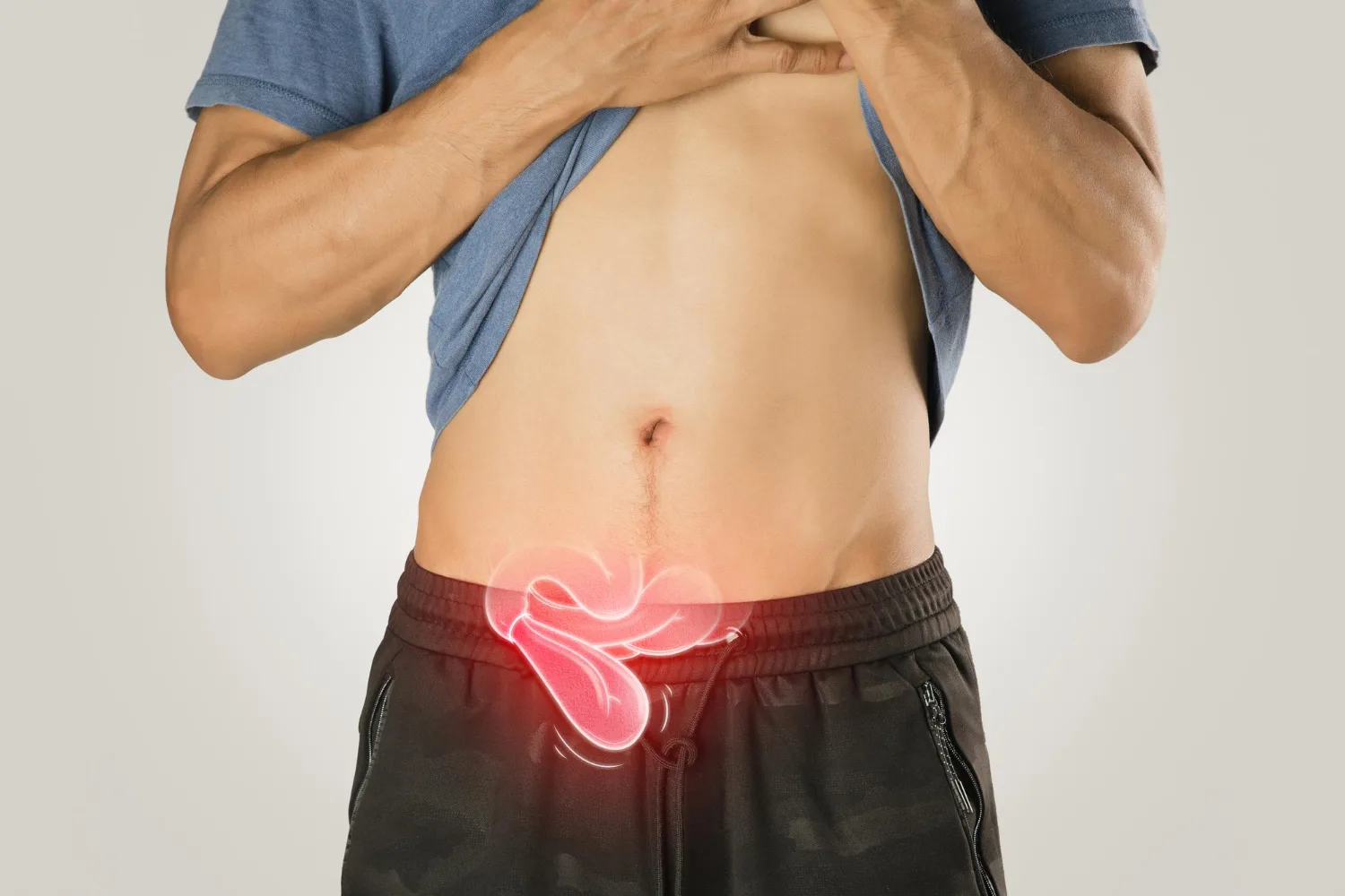 Cirugía de hernias en CDMX: Atención experta y recuperación rápida